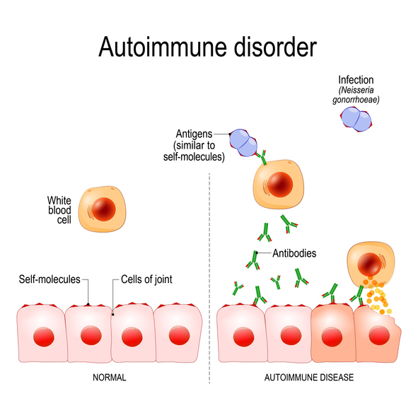Autoimmune disorders. For example Gonorrhea (sexually transmitted infection) and Arthritis. Antigens of bacterium Neisseria gonorrhoeae are similar to self-molecules of healthy joint cells. normal immune response can result in the production of antibodies that bind to healthy cells of joint, and caused of inflammation